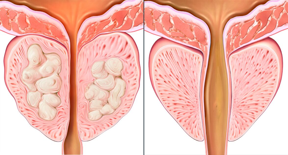 Phasen der Prostatitis-Behandlung mit Prostalix